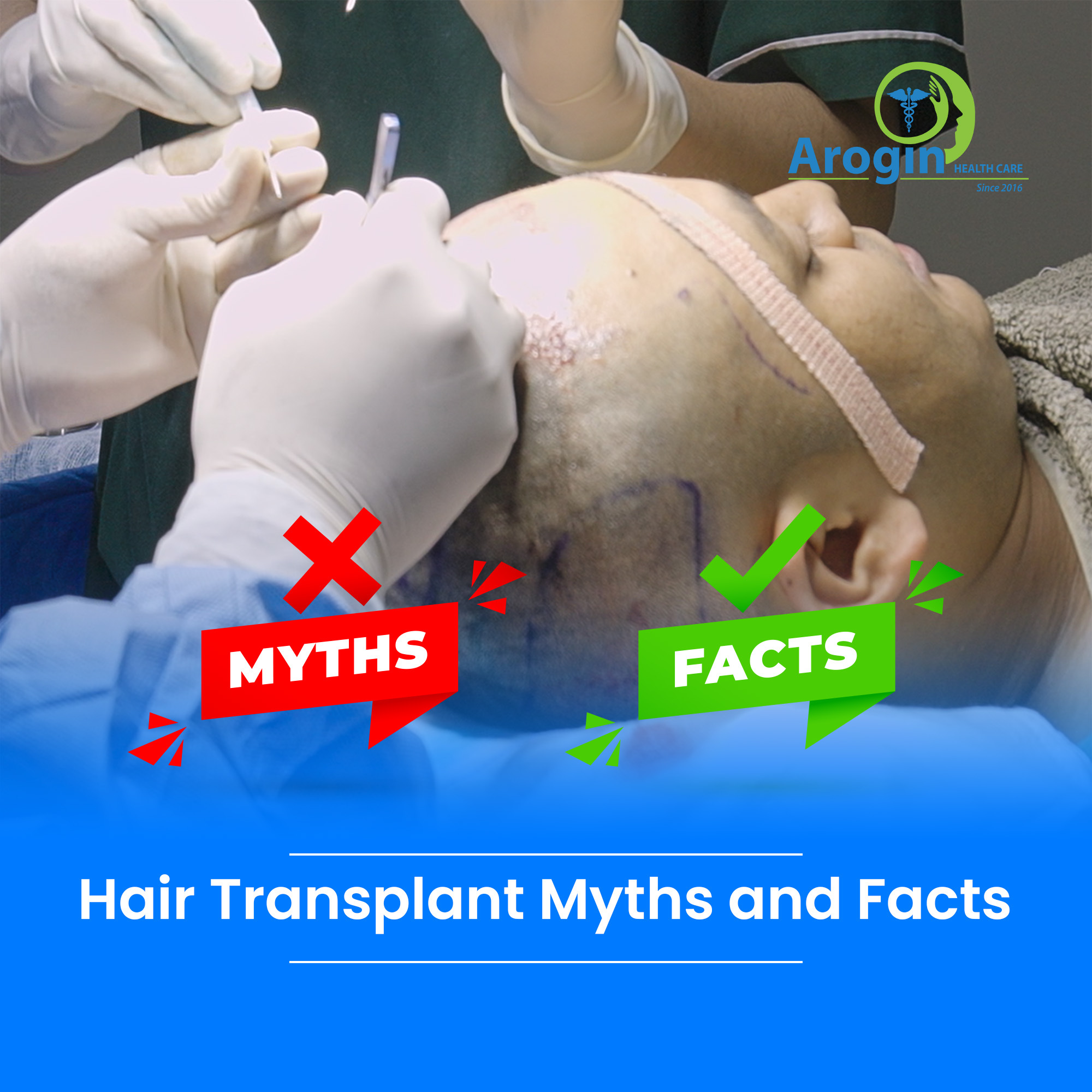 Hair Transplant Myths and Facts